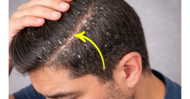 डैंड्रफ हटाने के घरेलू उपाय