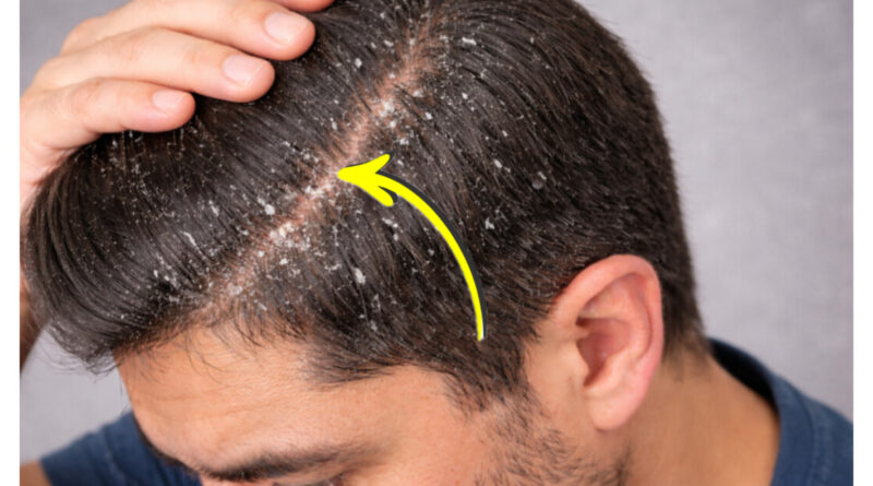 डैंड्रफ हटाने के घरेलू उपाय